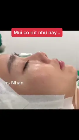 Nâng mũi cấu trúc sẽ giúp mũi dài và cao ra một cách an toàn. #nangmui #mui #plasticsurgery #rhinoplasty #pttm #cosmeticsurgery