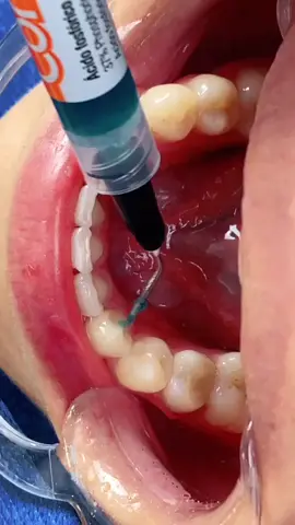 Férula fija 🇪🇨#dr #santodomingodelostsachilas #dredisoncriollo #cysdental #ecuador #santodomingo #viral #peru #venezuela #chile #brasil