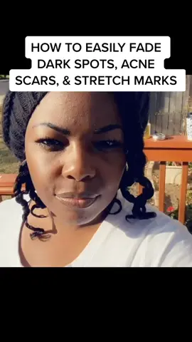 How to Easily Fade Dark Spots #skin #darkcircles #acnescars #skincare #foryou #stretchmarks #skintreatment #fypシ