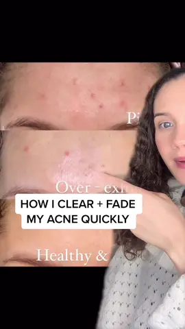 How to fade acne quickly ✨ #acne  #skincare #acnetreatment #myskincaretip