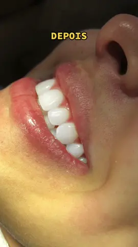 #foryoupage  #clareamentodental