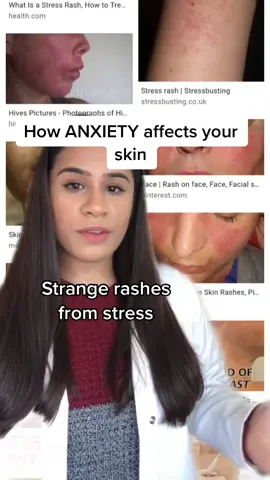 Inside health does determine the skins health massively  #readySETgo #acne #acnescars #MentalHealth #skincare #skincareroutine