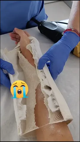 Después de tener una sierra funcionando. a pocos milímetros de mi brazo... #yeso #fractura #castremoval