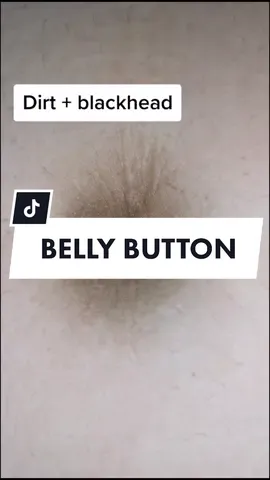 Belly button dirt #viral #2021 #belly #bellybutton #blackhead #blackheadsremoval #black #pusat #foryoupage #fyp #foryourpage #fypシ #fypage