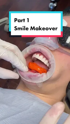 Part 1. Prep & Temp Veneers #reposting #video #since #audio #taken #down #viral #teeth #toothtok