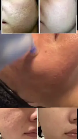 #zarpashbeautyclinic #drzarpashkhan #permanent #muscat #muscatoman #omani #travel #acnescars #pigmentation #uae #bahrain #kuwait #1MAuditionPK #foryou