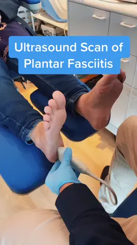 Ultrasound scan of plantar fasciitis #ultrasound #plantarfasciitis #heelpain #uk #british #fyp #birminghamuk #LearnOnTikTok #doctor