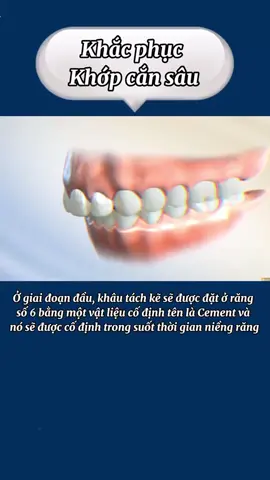 Sai khớp cắn hạng II ko thể bỏ qua nhé #nhakhoathuyduc #nhakhoauytin #LearnOnTikTok #ellastudy #niengrang