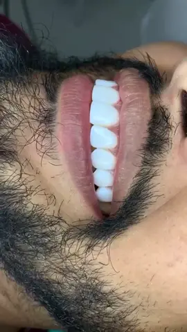 ✨ FACETAS DE RESINA ✨ #odontologia #facetasresina #facetas #odontologiamoderna #esteticadental #dentista