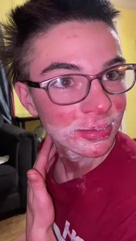 The result to my earlier video #fyp #stuntman #fireworks #herpes #burnt #ow #country #arkansas #razorbacks #mulletpower #diytiktok