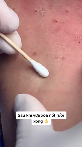 Tẩy xoá nốt ruồi bằng công nghệ Laser Fractional Co2 vô cùng an toàn hiệu quả nhanh chóng 😍#nốt_ruồi #làmđẹp #skincare #trend #xuhuongtiktok