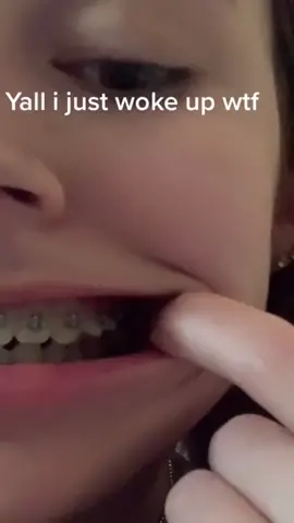 #stitch with @annabellesdrafts #dentist #dentistry #invisalign #orthodontics #londondentist #LearnOnTikTok #tiktoktutorial #sciencefacts #fy #fyp