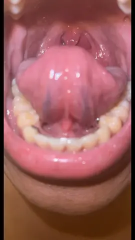 It feels like I keep swallowing my￼ uvula #sicktok #helpme #notcovid #medicaltiktok