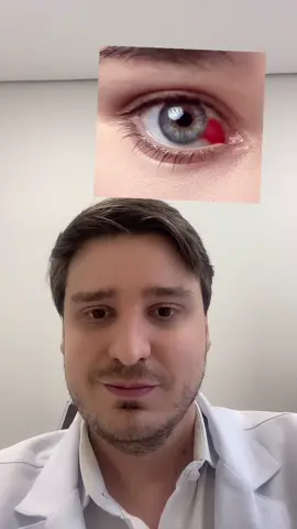 #hemorragia #hemorragiasubconjuntival #hiposfagma #oftalmologia #oftalmo #oftalmologista #sangue #blood #hemorragie #sanguenosolhos