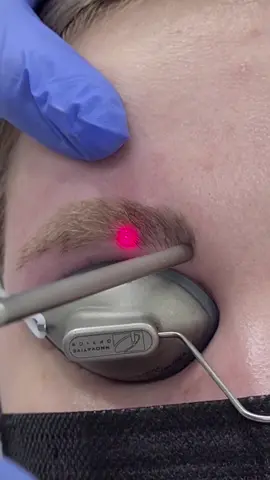Semi permanent eyebrow removal with the Fotona Q-switched Laser #fyp  #GlowUp #skincare #skinthings #laser #tattooremoval #furdich