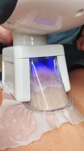 Криолиполиз для похудения позволяет за одно посещение уменьшить количество жировой ткани в зоне коррекции на 20-30% #криолиполиз #салонкрасоты #рек