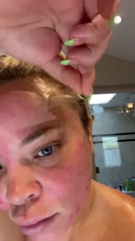 Que es el peeling? #foryou #parati #peeling