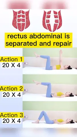 Rectus abdominal repair action#fyp #foryou #yogagirl #yogapose #yogalove #workout #homeyoga #thin