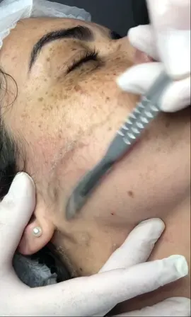 Dermaplaning Facial. #tiktok #foryou #esteticista #estética #dermaplaning #sãopaulo #rejuvenescimento