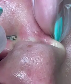 That was swirly 😵😍 #pimple #extractions #ouch