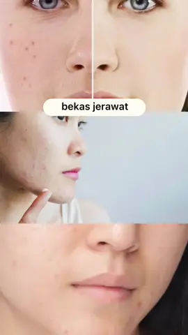 jujurly bagus bgt ni buat bekas jerawat @omniskinofficial #serumbekasjerawat #omniskinofficial