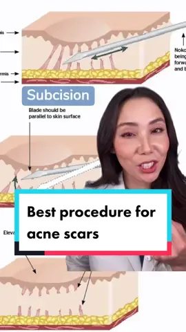 #dermatologist #acnescars #acnescartreatment #acne #LearnOnTikTok #tiktokpartner