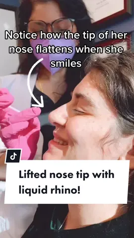 Lifting the nose tip with a non-surgical nose job! 😍💕 #beautybydrkay #foryoupage #foryou #nosejob #nosejobcheck #liquidrhinoplasty #plasticsurgery
