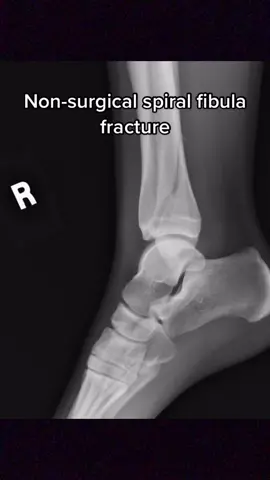 Still walking with a limp 3 months later. @footdocdana feel free to weigh in on this #skijumpingfamily #sportsinjury #surgery #recovery #athelte