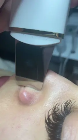 BT micro Black head extractions ! #xyvzbca #fyp #extractions #noseextractions #pimplepoper #drpipimplepopper