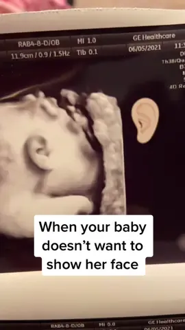 🤣🙄 #fyp #ultrasound #pregnant #pregnancy #3dultrasound #4dultrasound