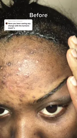 Reply to @vep.x The tumeric mask really helped clear up any dark marks that was left over from my teenage acne x #turmericmask #acnefighter #skincare