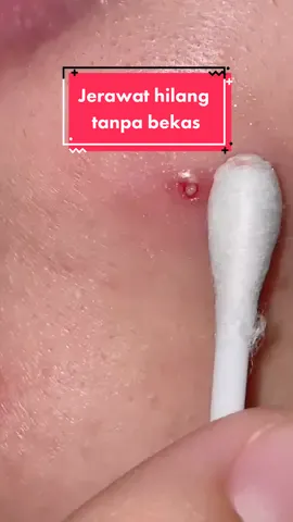 lihatlahhhh hilang tanpa bekas~ #acneserum #serumjerawat @malurshop1 #tokopediahaul @tokopedia #OnlyYou #serumbekasjerawat