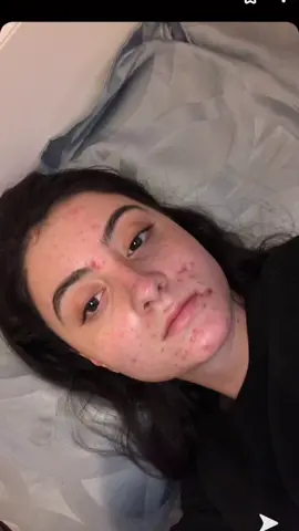 #greenscreen #accutanecheck #acnetreatment #acnecheck #acneskin #acnefighter #acnecheck #acneremoval #acnescars #acneremoval #acnetips #acnetips #acne