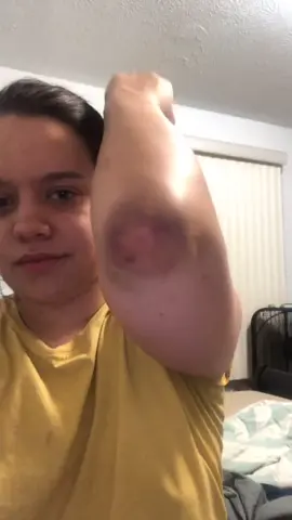 Basically I bruise like a peach #bruise #injury #ouch