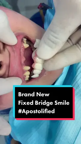 Never too late to have a confidently beautiful #apostolified smile fixed bridge and #veneers ❤️ #dentistry #smile #teeth #fyp #tiktokph #dentista #xyz
