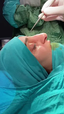 🧙‍♀️🧙‍♀️🧙‍♀️ Magic🧙‍♀️🧙‍♀️🧙‍♀️ #septorhinoplasty #rhinoplastie #piezorhinoplasty #rinoplastika