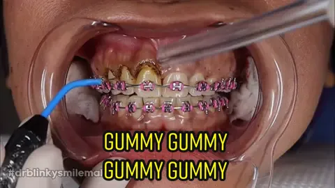 Gummy smile no more with electrocautery #gingivectomy #gummysmile #smilemakeover #braces #dental #smiletransformation #foryou #foryoupage fb on my bio