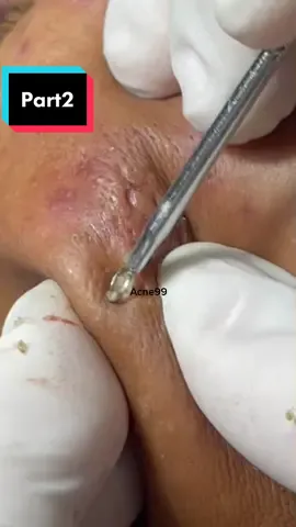#លីមីធម្មជាតិ #acnetreatment #cambodia