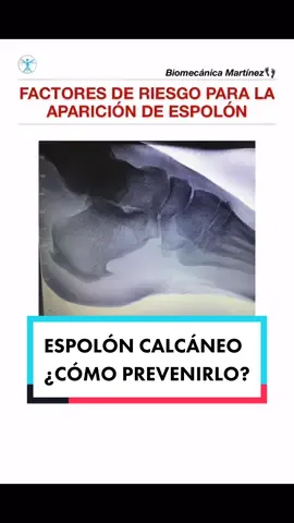 ⚠️ Prevenir es mejor que tratar.  #espolon #espolones #espoloncalcaneo