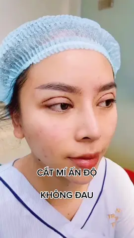 CA CẮT MÍ ẤN ĐỘ ĐƯỢC THỰC HIỆN SAU 30 PHÚT ĐỒNG HỒ CẢ NHÀ CÙNG XEM KẾT QUẢ NHƯ THẾ NÀO NHA#phauthuat #lamdep #phunu