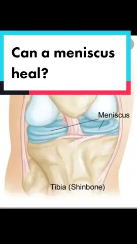 Reply to @cuttiev323 meniscus tear. #kneepain #meniscus #meniscussurgery #meexplain #acupuncturebrisbane #OOTD #health