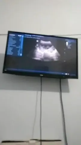 #fypシ #fypシ゚viral dan ini mentahannya usg anak aku yang ke2 ya gays, Alhamdulillah bainya sehat slalu