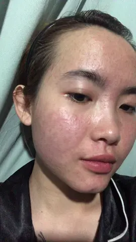 Ai có kinh nghiệm điều trị da nhiễm corticoid cho em xin bí quyết với ạ 😞