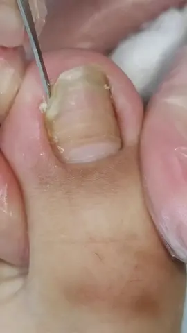 #ingrowntoenail #ingrowntoenailremoval #ingrownnail #ingrown #ingrowntoenailsurgery #infectedingrowntoenail #ingrowntoenailtreatment