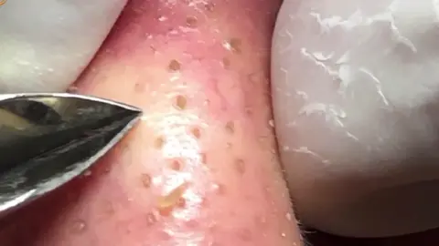 #ฟีลสนุกปลุกไอเดีย #สิว #บีบสิว #กดสิว #สิวเสี่ยน #acne