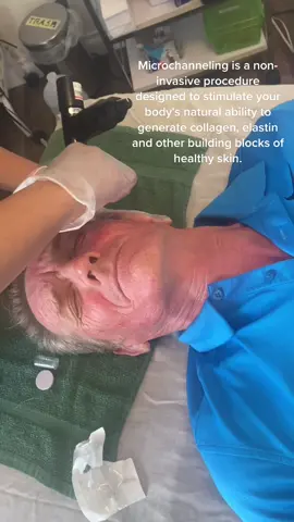 #microchanneling #fyp #fypシ #fypシ゚viral #fypdongggggggg #fypdong #fypage #foryoupage #foryourpage #esthetician #skincare #facialtreatment #facialtime