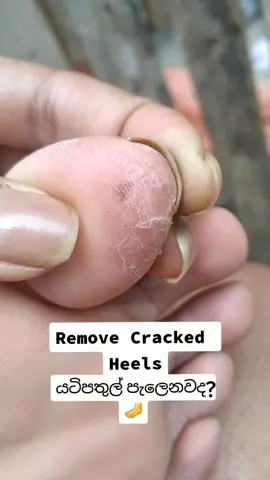 යටිපතුල් පැලෙනවට සාර්ථක ප්‍රතිකර්මයක්❤️ How To Remove Cracked Heels❤