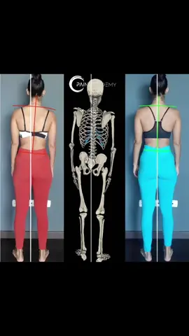 She came to us after searching for years for back pain relief. We showed her that nothing was wrong with her back - she wasn’t able to use both legs the same. You can see how she veers off to the right. By showing her how to rebalance her leg function, her back pain went away. #balance #Fitness #backpain #hips #spine