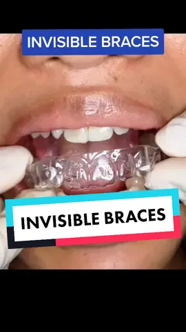 INVISIBLE BRACES/ALIGNERS #ALIGNERS #alignersjourney  #invisiblebraces #clearbraces #braces #bracescheck #dentistry #dentaltok #dentaltips #dental