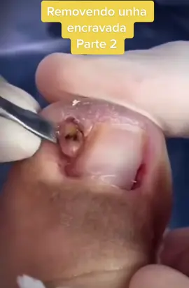 ##unha #unhagigante #fy #satisfying #encravada #satisfatório